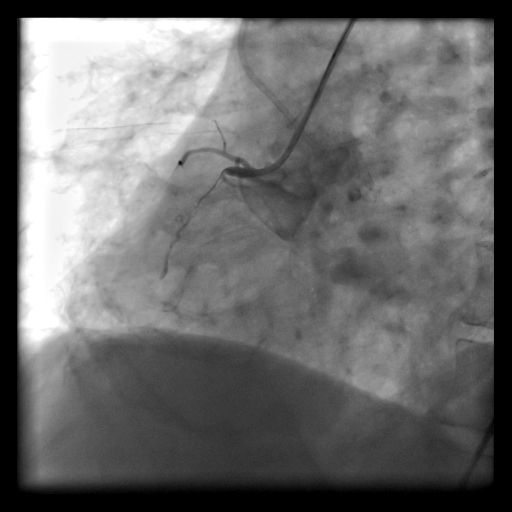 Kronik Tam Tıkalı Kalp Damarında Balon/Stent İşlemi  