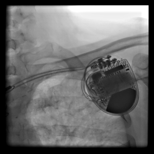 Öldürücü Ritmi Önleyen Pil (ICD) 