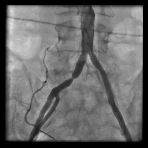 Periferik (kol,  ayak) Damarlarda Balon/Stent İşlemi 