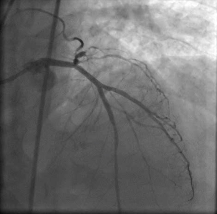 Ana Dal ile Birlikte Yan Dal(lar)ı da Tutan Çatal Lezyonlarda (daralma)  Balon/Stent İşlemi 